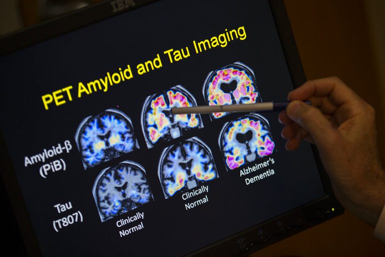 Early Alzheimer S Detection