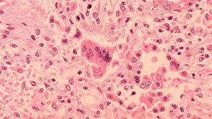 Measles Exposure At Hollywood Burbank Airport