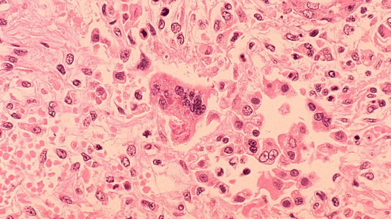 Measles Exposure At Hollywood Burbank Airport