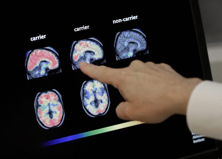 Unt Health Research Explores Alzheimer S In Down Syndrome
