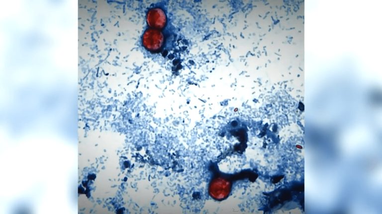 Connecticut Sees 35 Cyclosporiasis Cases