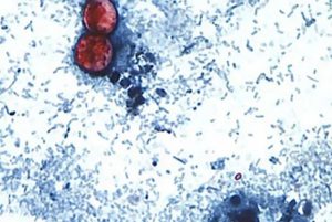 Cyclospora Outbreak Hits Johnson County