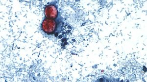 Cyclospora Parasite Cases Rise