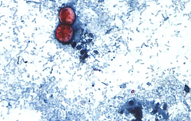 Cyclosporiasis Outbreak In Cleveland