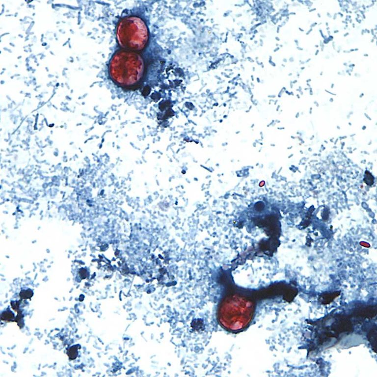 Florida Cyclospora Outbreak