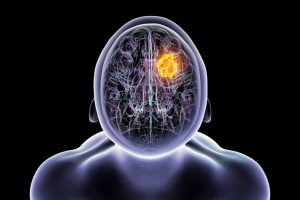Glioblastoma Awareness