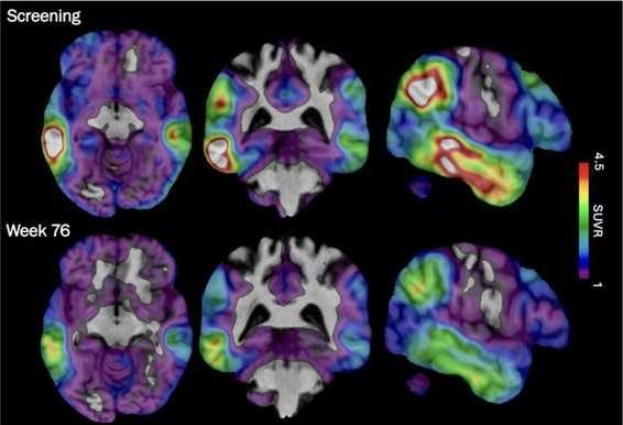 New Alzheimer S Drug Shows Promise