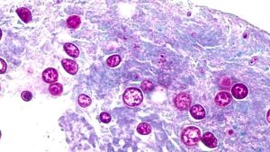 Nh Hospital Cafeteria Linked To Cyclospora Outbreak