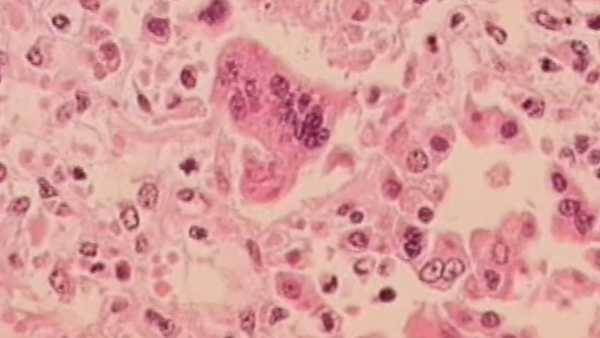 Ohio Reports Third Measles Outbreak Of 2026