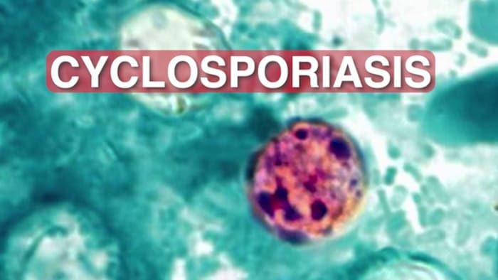 Parasite Outbreak Hits Texas