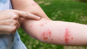 Poison Ivy Rash Relief
