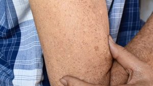 Sunspots Vs Freckles
