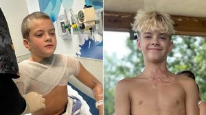 Teen Suffers Third Degree Burns From Viral Tiktok Trend