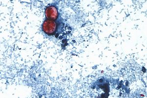 Cyclospora Outbreak Linked To Recalled Iceberg Lettuce Spreads To 20 States