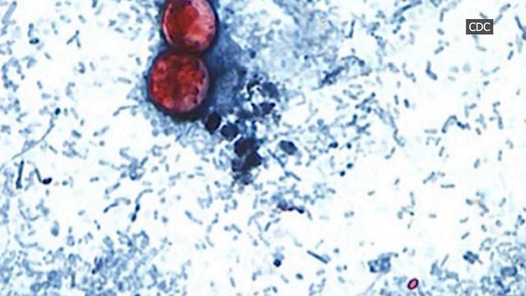 Cyclosporiasis Outbreak Claims Lives