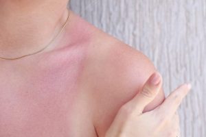 How To Distinguish Heat Rash From Sunburn And Treat Each Safely
