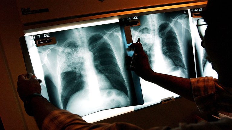 Irving Isd High School Investigated For Tuberculosis Exposure