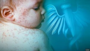 Kentucky Health Dept Alerts Richmond And Olive Hill Residents To Possible Measle
