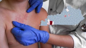Kentucky Measles Outbreak Reaches 24 Cases As New Counties Report Infections
