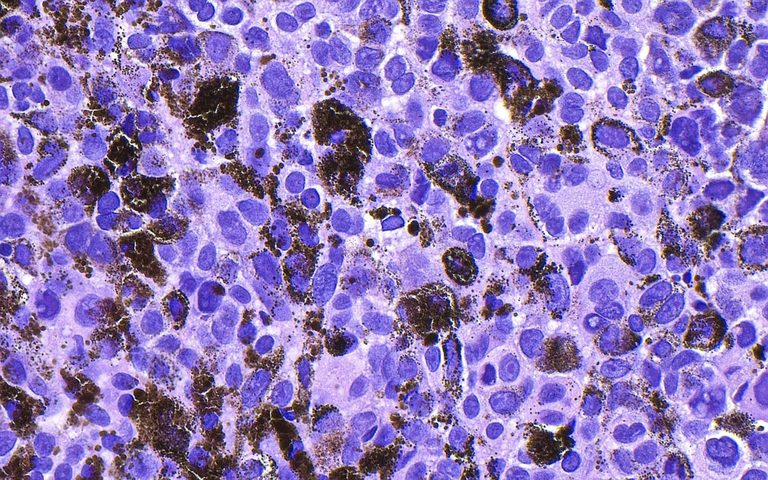 Moderna And Merck Report Success For Personalized Melanoma Vaccine In Late Stage