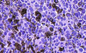 Moderna And Merck Report Successful Melanoma Vaccine Trial