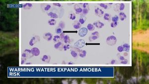 North Carolina Teen S Rare Brain Infection Highlights Expanding Heat Linked Amoe