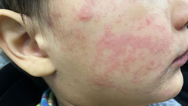Oregon Measles Cases Surge