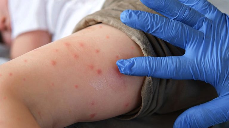 Pennsylvania Reports First Measles Deaths In 35 Years As Cases Surge Statewide