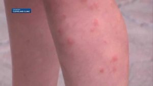 Scratching Bug Bites Can Worsen Symptoms