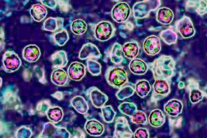 Two Unvaccinated Pennsylvanians Die From Measles Health Dept Reports
