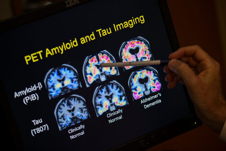 Doctors Advise Lifestyle Changes Over Unproven Blood Tests For Dementia Risk