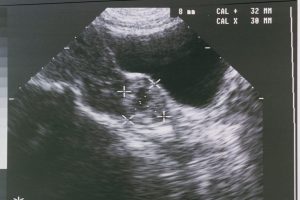 Ectopic Pregnancy Deaths Rise Sharply With Texas Seeing Steepest Increase Under