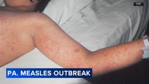 Fifth Measles Related Death Reported In Pennsylvania As Cases Near 1 000