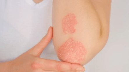 Fort Worth Dermatologist Notes Possible Skin Benefits From Glp 1 Weight Loss Dru