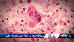 Measles Cases Rise To Six In Trigg County As Health Officials Urge Vaccination