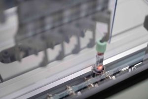 New Blood Test Detects Early Stage Pancreatic Cancer With High Accuracy