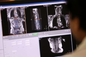 New Mri Dye Detects Tiny Lung Tumors Early J J Drug Helps Depression Related Sex