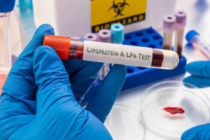 One In Five Americans May Carry Hidden Genetic Stroke Risk Experts Say