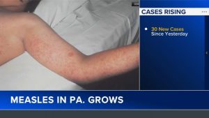 Pennsylvania Measles Cases Rise To 624 As Health Officials Boost Vaccinations