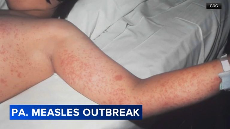 Pennsylvania Measles Outbreak Tops 800 Cases As Vaccination Demand Surges