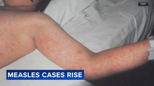 Philadelphia Faces Rising Measles Cases As Cdc Records First Death