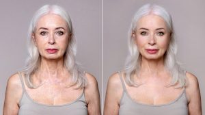 Plastic Surgeon Advises Against Premature Facelifts And Warns Of Delayed Surgery