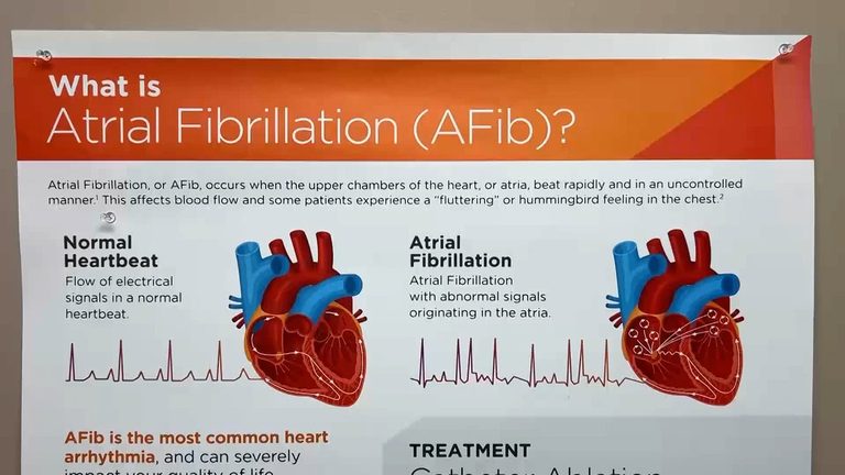 Santa Maria Doctors Alert Rise In Atrial Fibrillation Cases During Awareness Mon