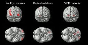 Scientists Identify 36 Genes Linked To Ocd And Tic Disorders Opening New Treatme