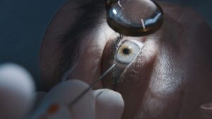 Shreveport Doctors Highlight New Laser Cataract Surgery Options