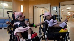 St Louis Hospital Separates Craniopagus Twins After 25 Hour Surgery