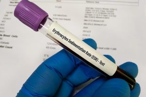 Why The Four Hour Esr Rule Holds Back Faster More Accurate Lab Testing