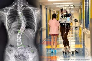 Bearden Teen Dancer Gains Height And Returns To Aerial After Scoliosis Surgery