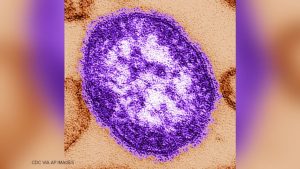 Chester County Health Dept Alerts Residents To Possible Measles Exposure At Loca