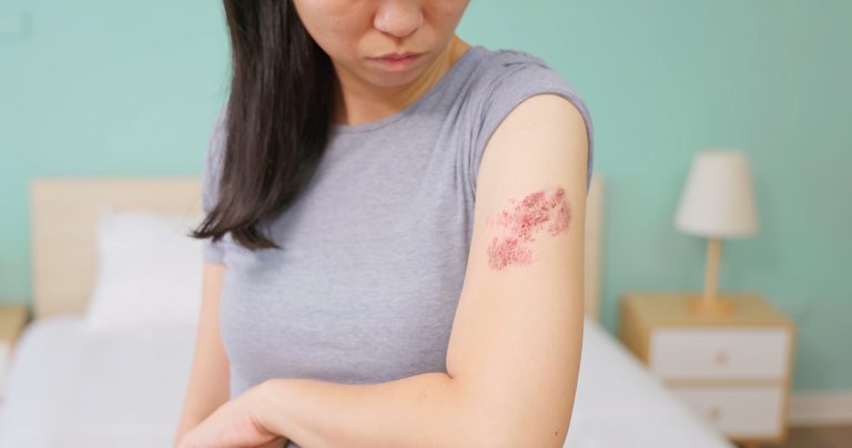 Chickenpox Vaccine Linked To Sharp Decline In Shingles Among Young Adults